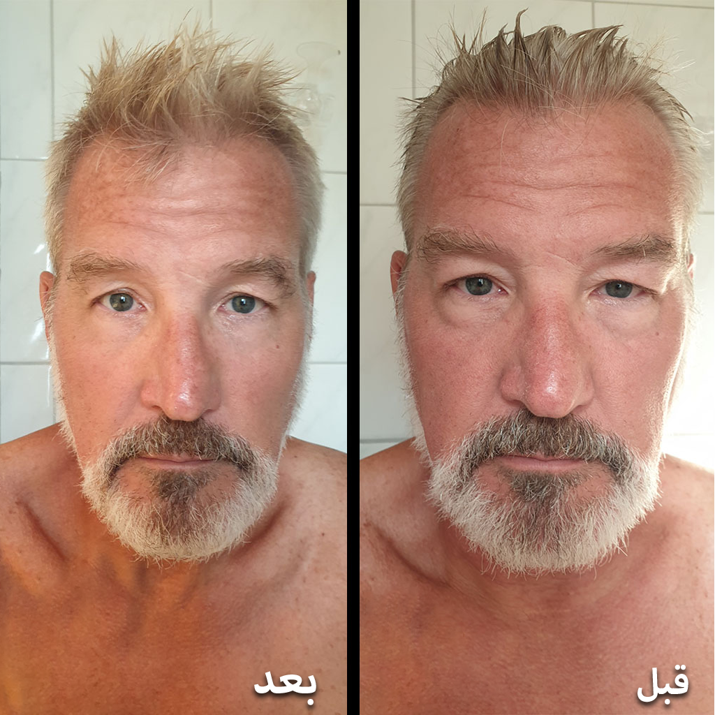 jeremy lea before and after photos using particle for men