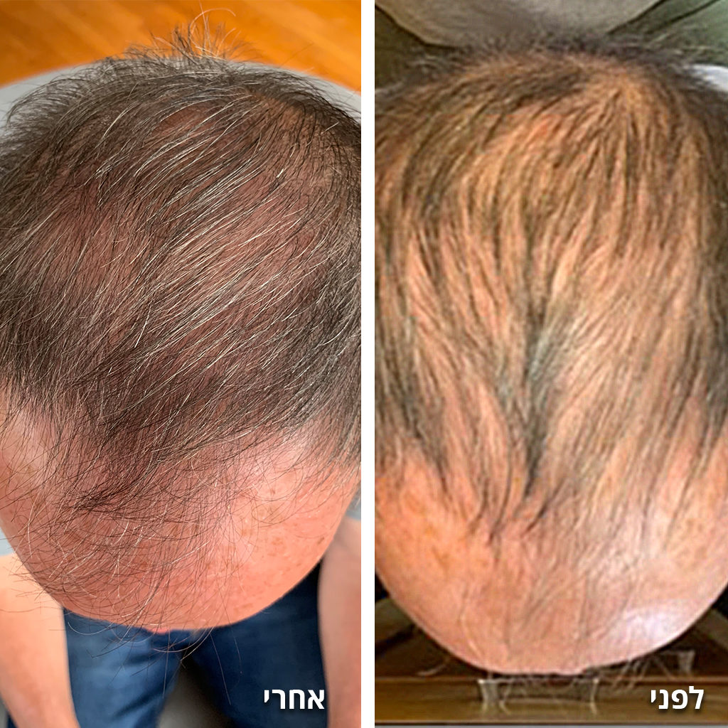 Hair Revival Kit Results Hebrew