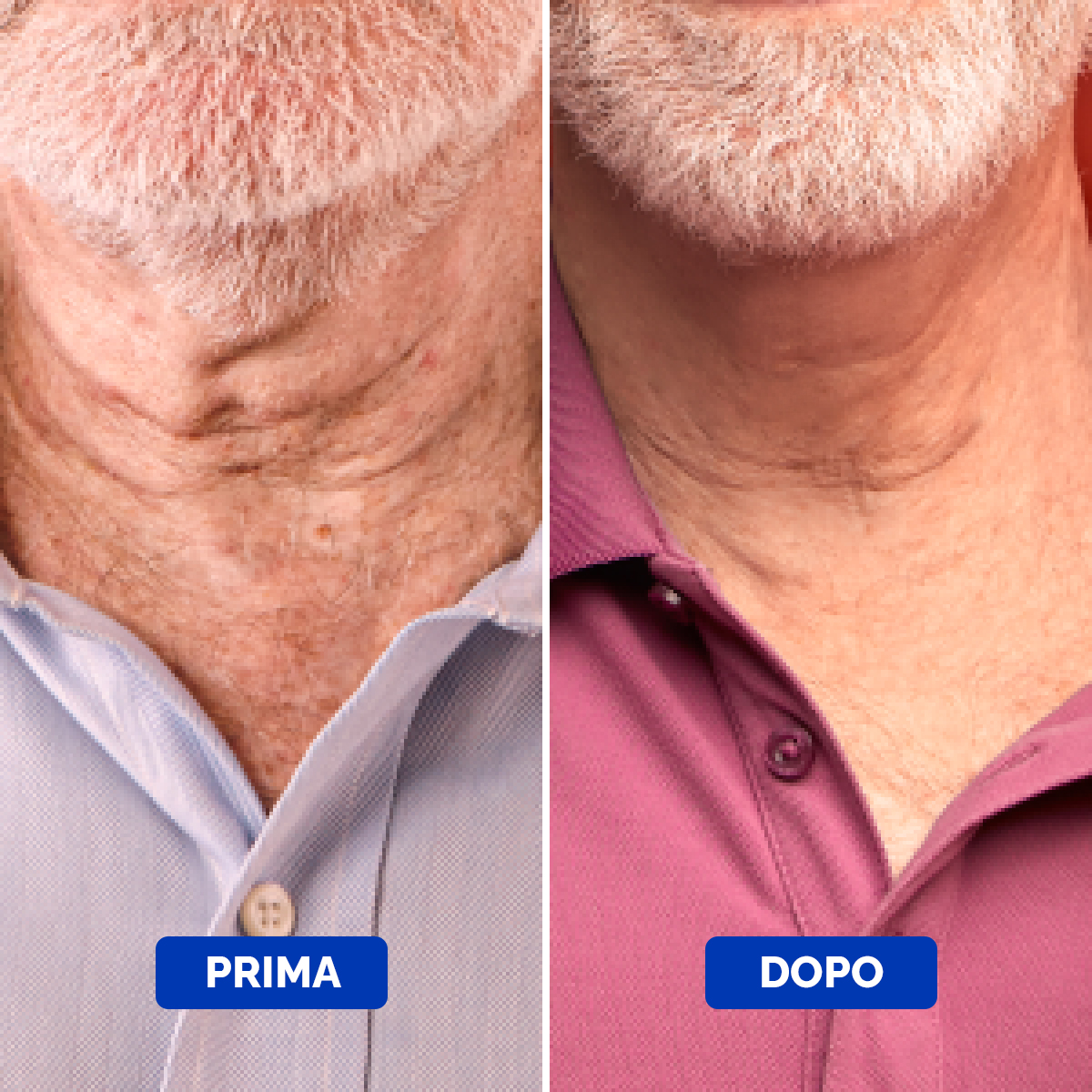Neck Cream Before & After 3 Italian