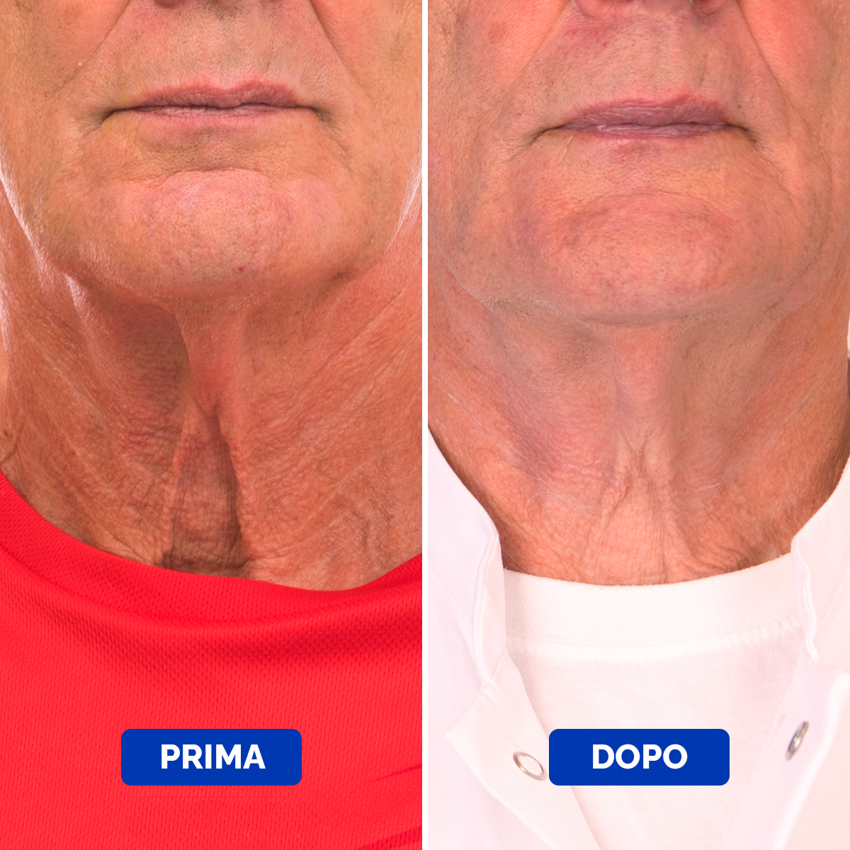 Neck Cream Before & After 4 Italian