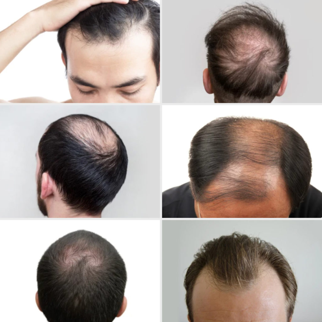 Hair Loss Degrees New