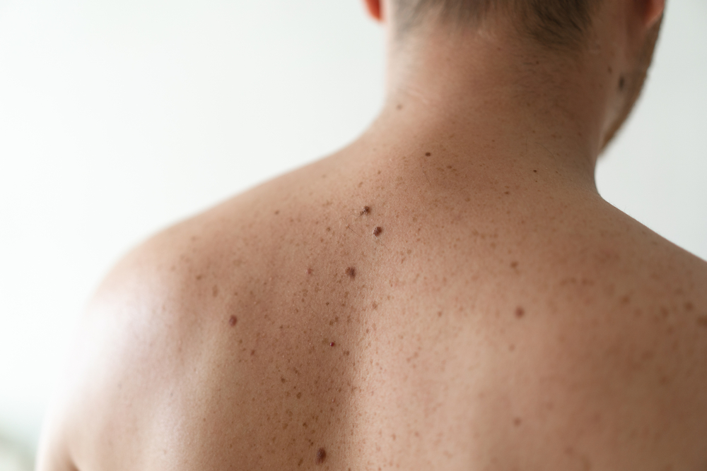 If the mole starts to itch or hurt, you should definitely see a dermatologist