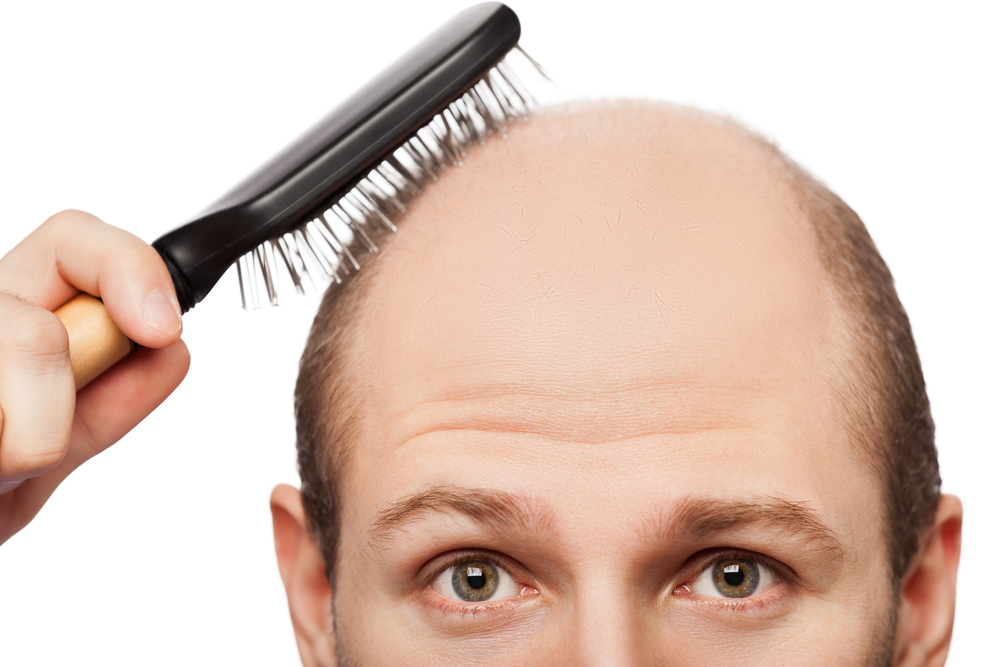 Usually, the causes of hair loss are natural, that is, hereditary.