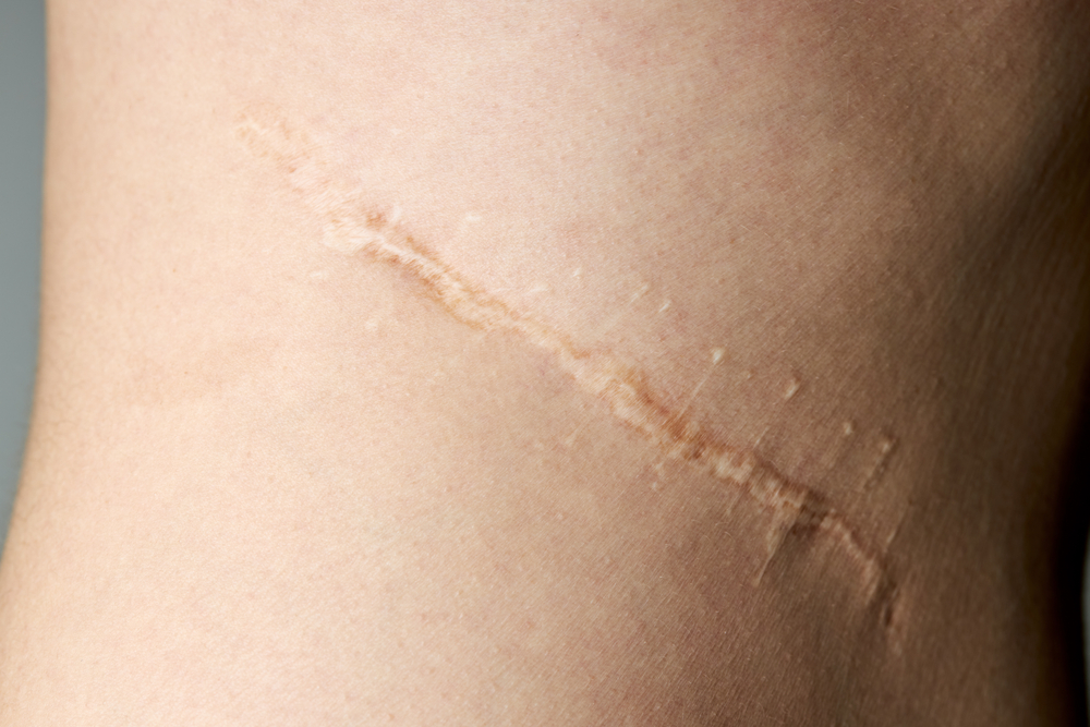The body keeps producing collagen after the wound is sealed, causing raised – hypertrophic or keloid scars.