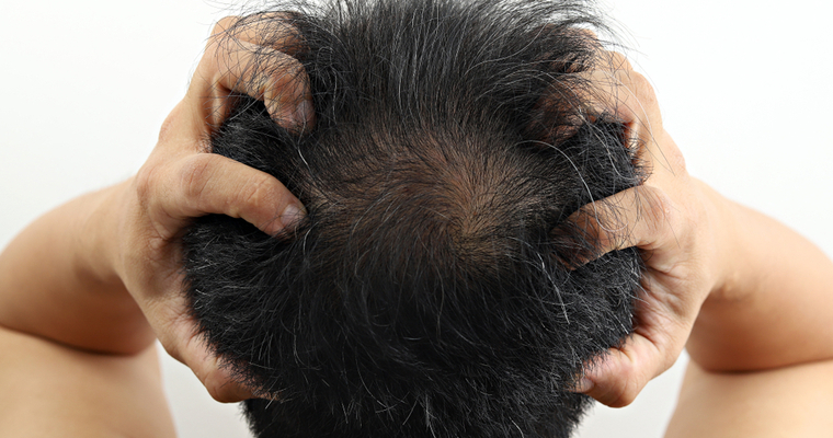 Does Stress Cause Hair Loss? - Particle