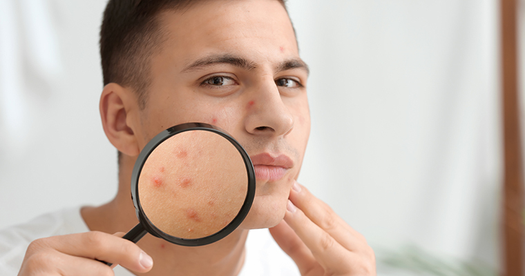 Young-Man-Looking-At-His-Pimples-Acne