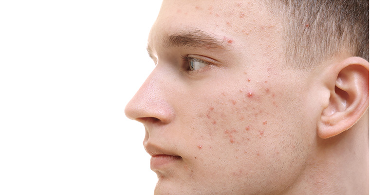 Man-With_Acne-Scars-Pimples