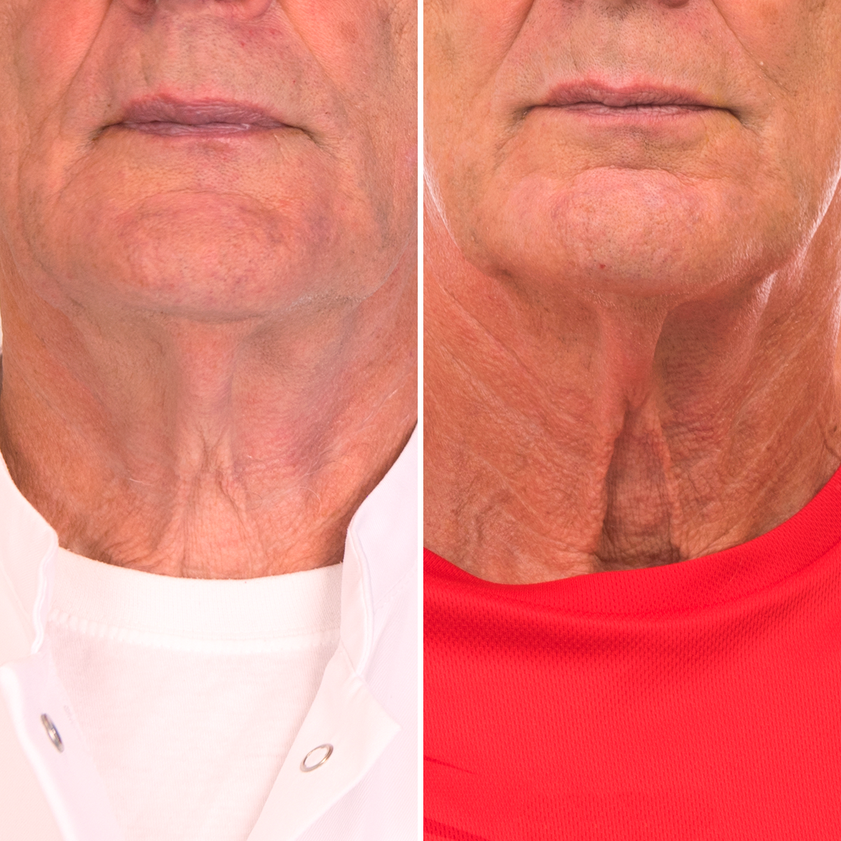 Particle Neck Cream Before & After 2 Flipped
