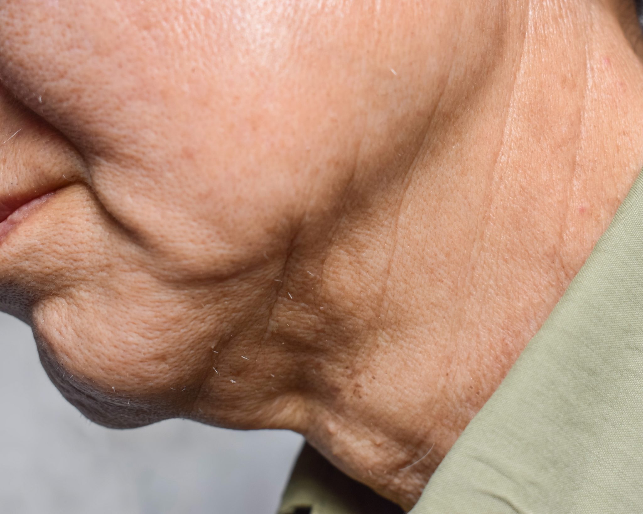 Aging,Skin,Folds,Or,Skin,Creases,Or,Wrinkles,Of,Southeast