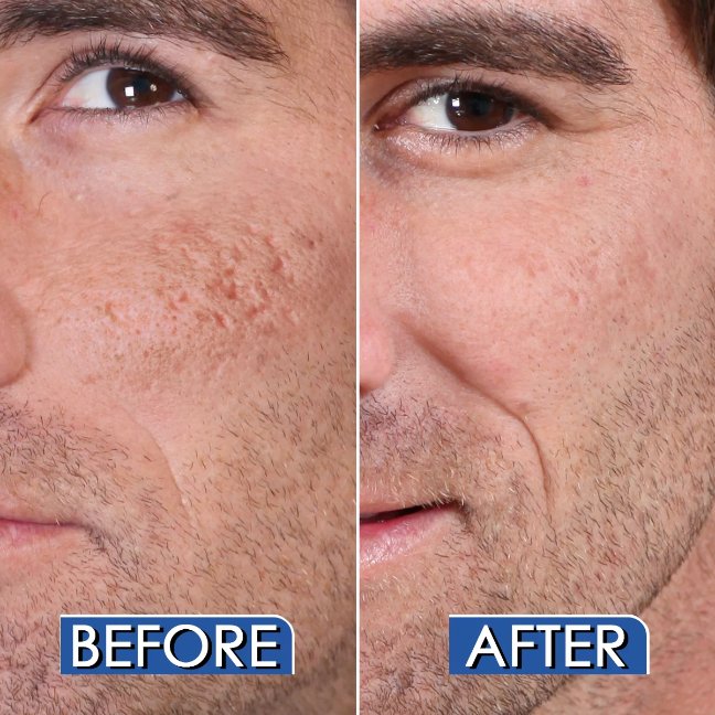 Scar-Gel-Before-and-After-Acne-2