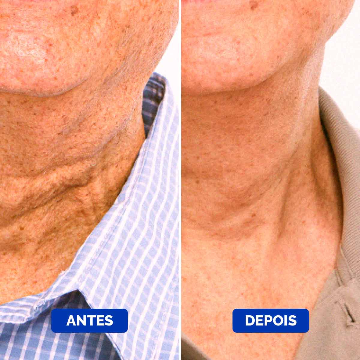 Neck-Cream-Before-&-After-1_1200x1200_Portuguese_Compressed