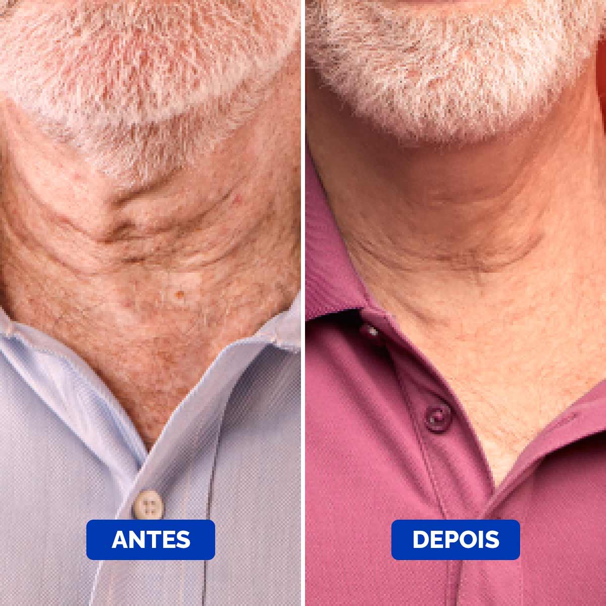 Neck-Cream-Before-&-After-3_1200x1200_Portuguese_Compressed