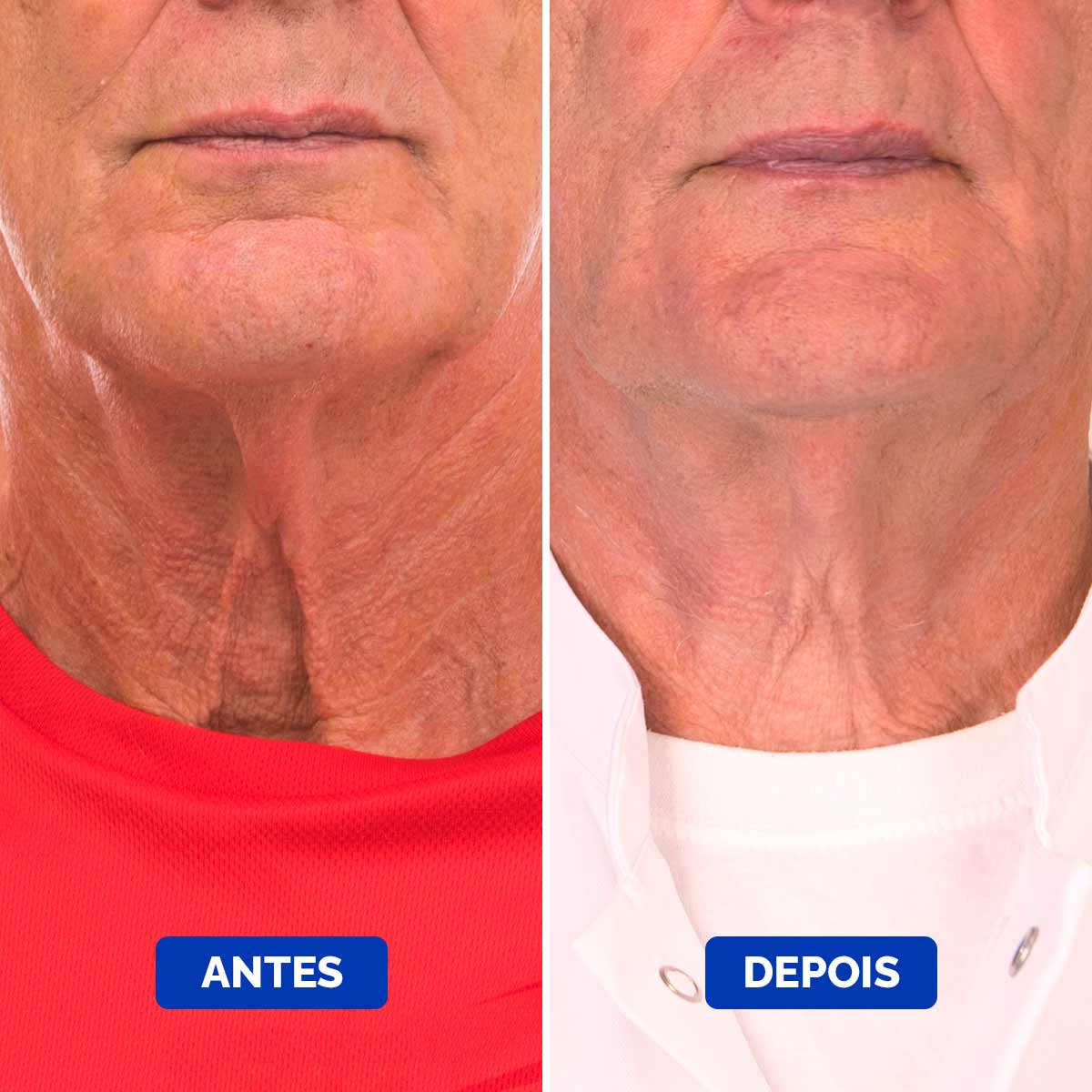Neck-Cream-Before-&-After-4_1200x1200_Portuguese_Compressed